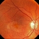 Wet Age Related Macular Degeneration (WET AMD) Wet Age Related Macular Degeneration (WET AMD)